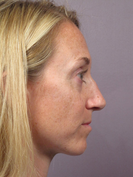 Nose Reshaping before and after photo