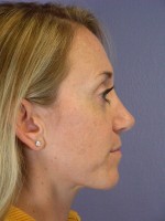 Nose Reshaping Before and after photo