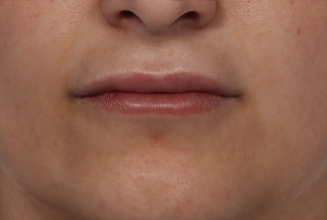 Injectable Fillers before and after photo