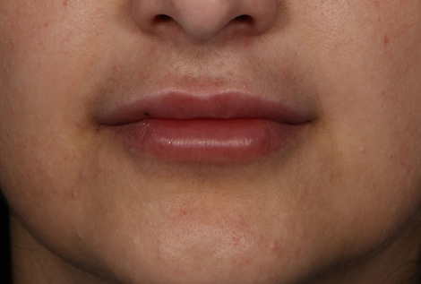 Injectable Fillers before and after photo