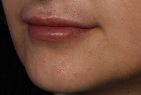 Injectable Fillers before and after photo