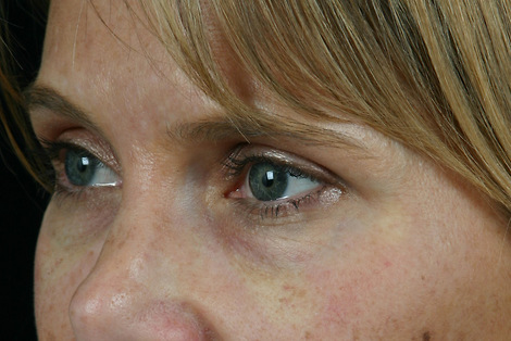 Injectable Fillers before and after photo