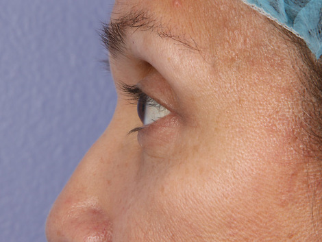 Eyelid Surgery before and after photo