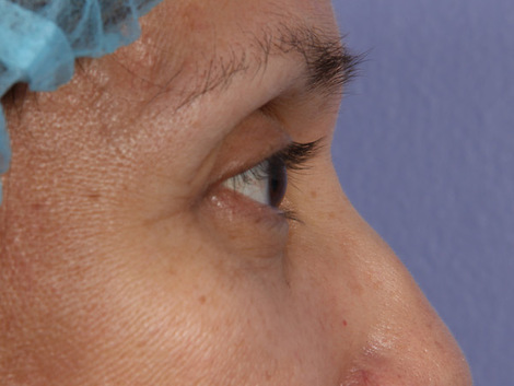 Eyelid Surgery before and after photo