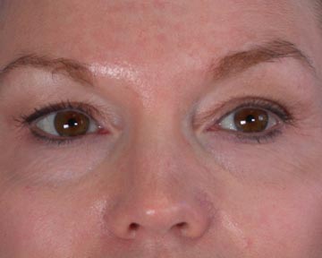 Eyelid Surgery before and after photo