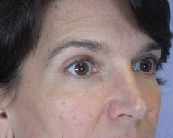 Eyelid Surgery before and after photo