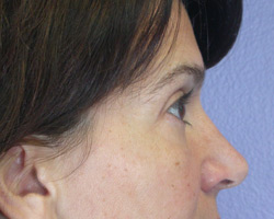 Eyelid Surgery before and after photo