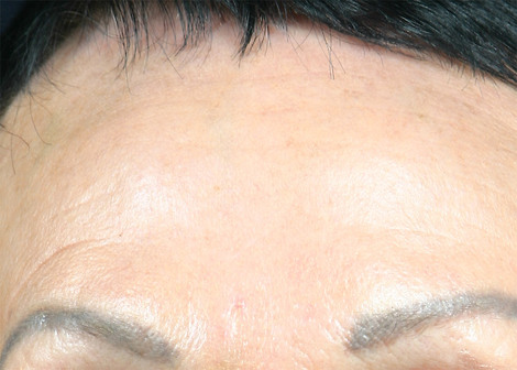 Injectable Fillers before and after photo