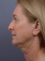 Eyelid Surgery Before and after photo