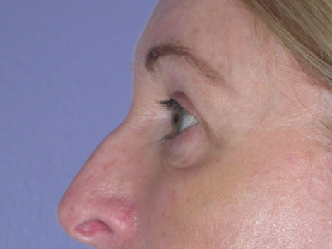 Eyelid Surgery before and after photo