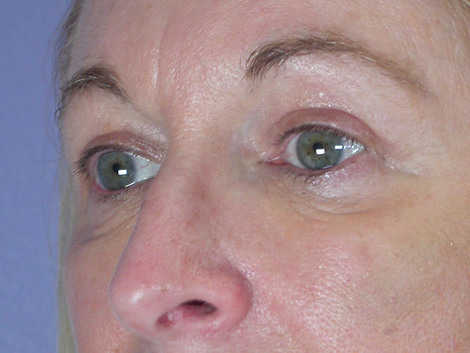 Eyelid Surgery before and after photo