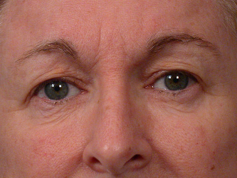 Eyelid Surgery before and after photo