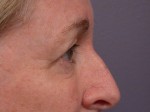 Eyelid Surgery Before and after photo