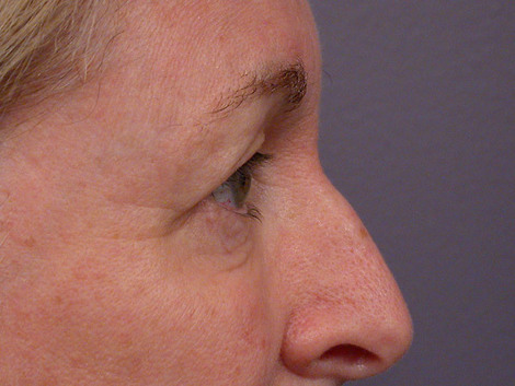 Eyelid Surgery before and after photo