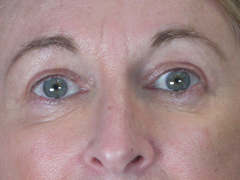 Eyelid Surgery before and after photo