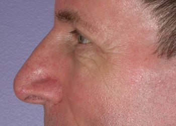 Eyelid Surgery before and after photo