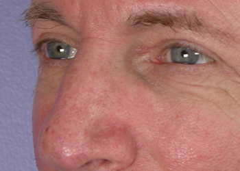 Eyelid Surgery before and after photo