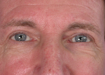 Eyelid Surgery before and after photo