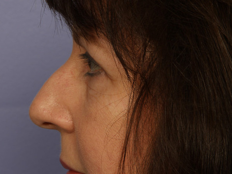 Eyelid Surgery before and after photo