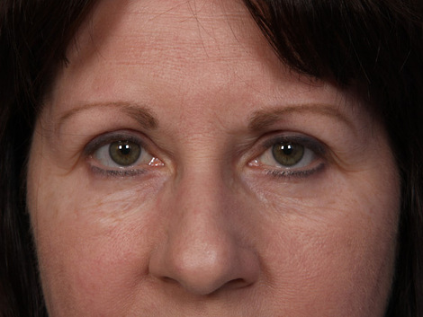 Eyelid Surgery before and after photo