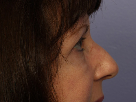 Eyelid Surgery before and after photo