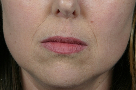 Injectable Fillers before and after photo