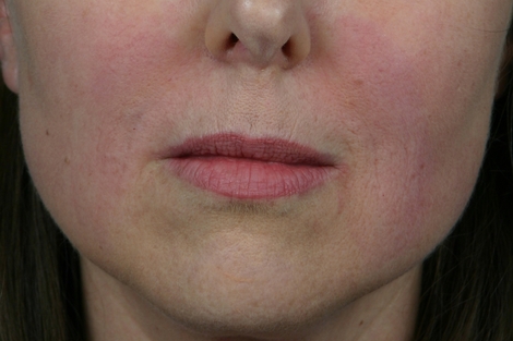 Injectable Fillers before and after photo