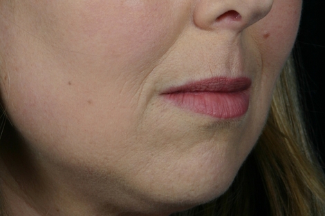 Injectable Fillers before and after photo