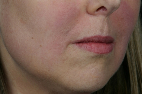 Injectable Fillers before and after photo