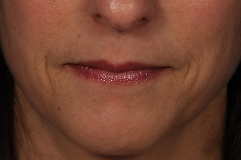 Injectable Fillers before and after photo