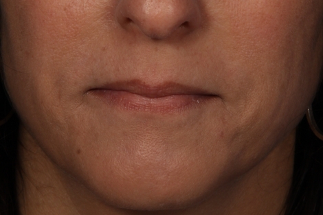 Injectable Fillers before and after photo