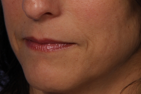 Injectable Fillers before and after photo