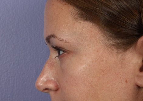 Eyelid Surgery before and after photo