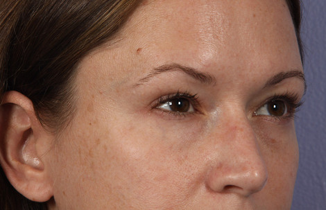 Eyelid Surgery before and after photo