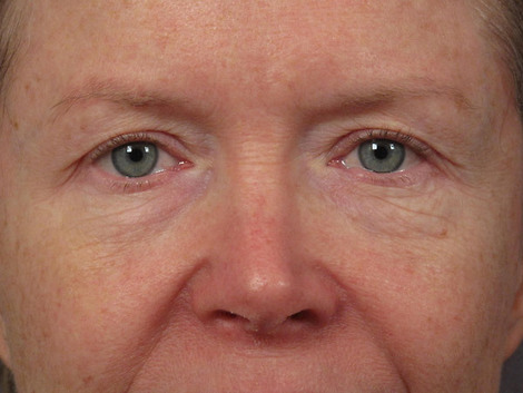 Eyelid Surgery before and after photo