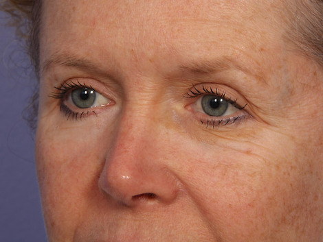 Eyelid Surgery before and after photo