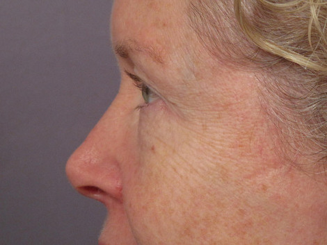 Eyelid Surgery before and after photo