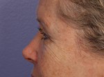 Eyelid Surgery Before and after photo