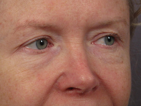 Eyelid Surgery before and after photo