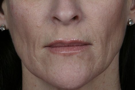 Injectable Fillers before and after photo