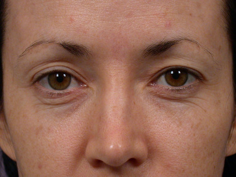 Eyelid Surgery before and after photo