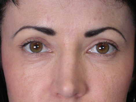 Eyelid Surgery before and after photo