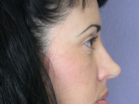 Eyelid Surgery before and after photo