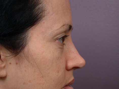 Eyelid Surgery before and after photo