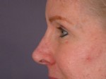 Eyelid Surgery Before and after photo