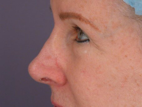 Eyelid Surgery before and after photo