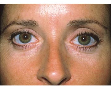 Eyelid Surgery before and after photo