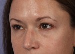 Eyelid Surgery Before and after photo