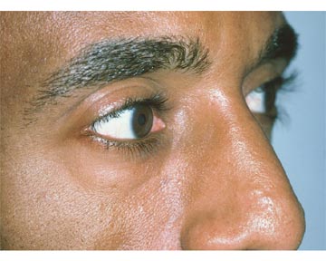 Eyelid Surgery before and after photo