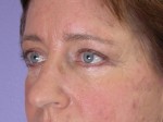 Eyelid Surgery Before and after photo